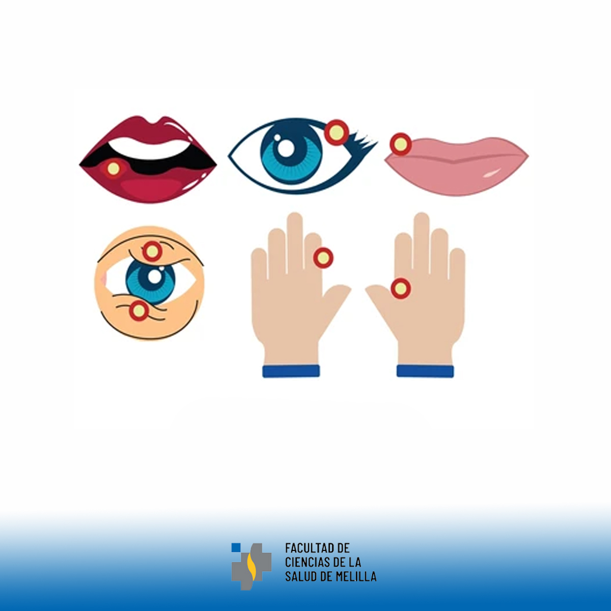 Día Mundial del Angioedema Hereditario