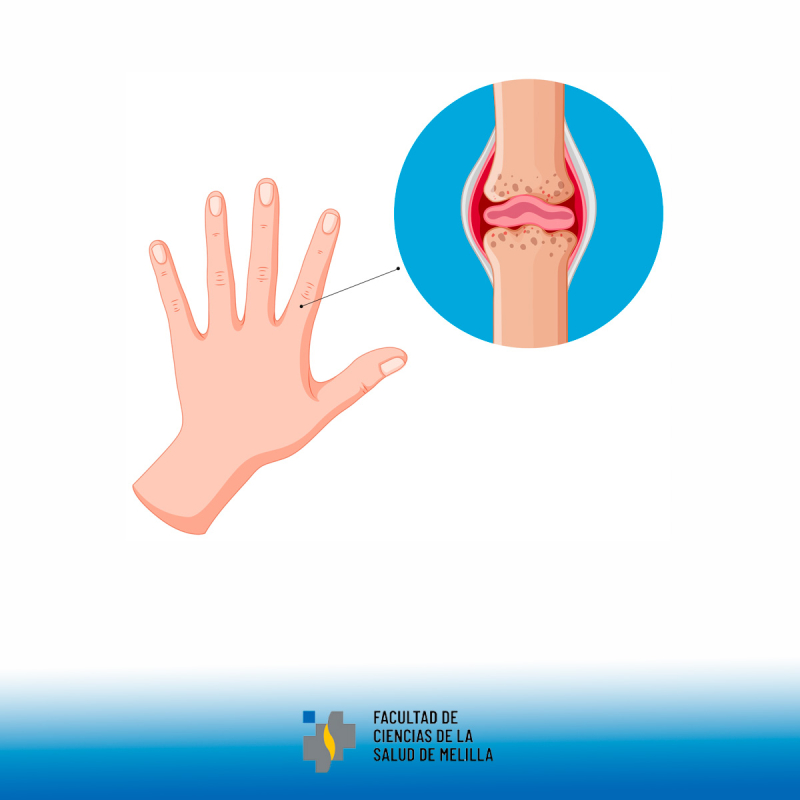 D铆a Mundial de la Artritis D铆a Mundial de la Artritis
