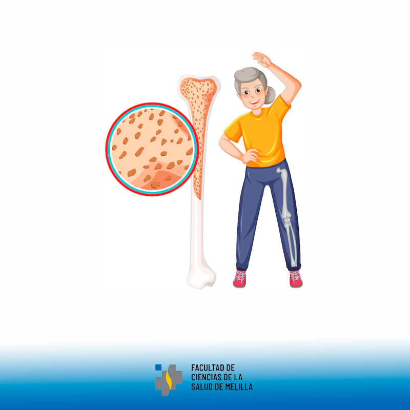 Día Mundial de la Osteoporosis Día Mundial de la Osteoporosis