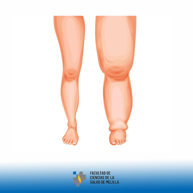 馃Φ馃挋 D铆a Internacional del Linfedema: concienciaci贸n, tratamiento y calidad de vida 馃Φ馃挋 D铆a Internacional del Linfedema: concienciaci贸n, tratamiento y calidad de vida