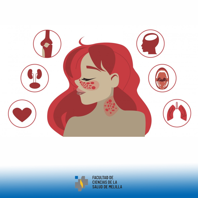 D铆a Mundial del Lupus D铆a Mundial del Lupus