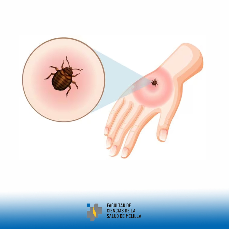D铆a Mundial de la Enfermedad de Lyme D铆a Mundial de la Enfermedad de Lyme