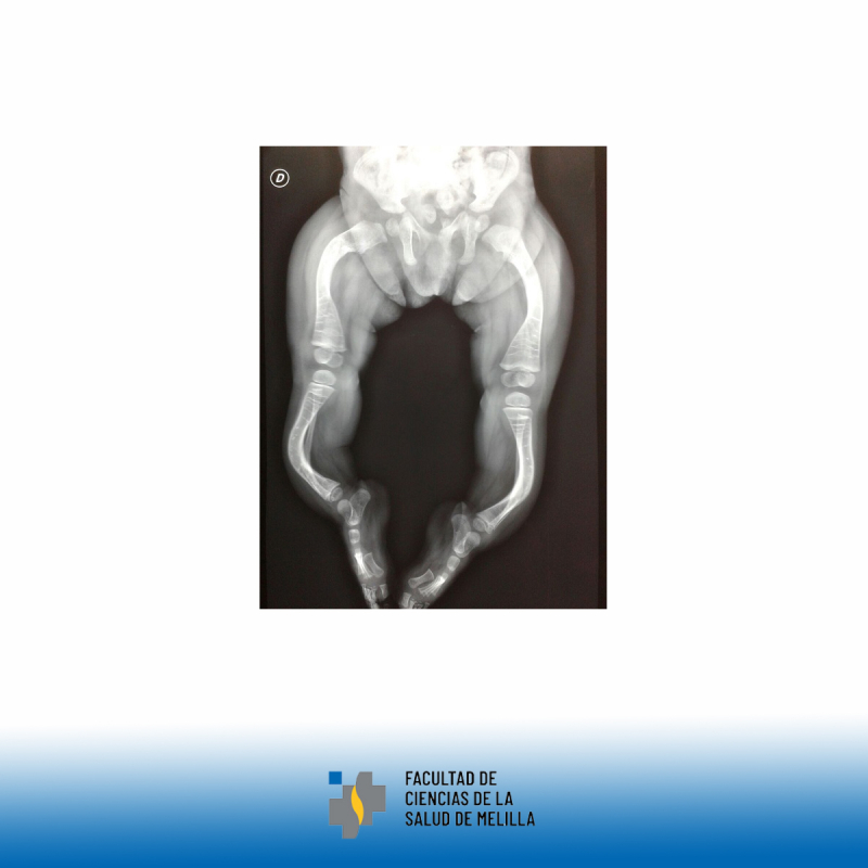 Día Internacional de la Osteogénesis Imperfecta Día Internacional de la Osteogénesis Imperfecta